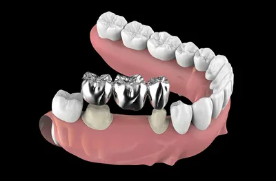 Золотые Зубы Коронки Над Естественными Зубами Медицинская Точная 3d  Иллюстрация Лечения Зубов Человека — стоковые фотографии и другие картинки  Анатомия - iStock