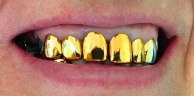 Sadaf Dental Clinic - Ещё один счастливый пациент! 😍 ⠀ 💡 В конце 90-х и в  начале нулевых было модно иметь золотые зубы, но сейчас она давно осталась  в прошлом. Теперь их