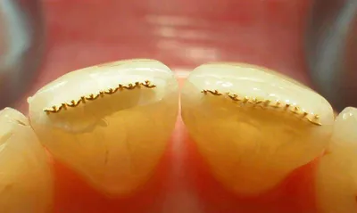 Зуб из стекловолокна фото фотографии