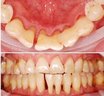 Шинирование зубов в стоматологии стекловолокном при пародонтите и  пародонтозе: процедура для подвижных зубов