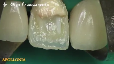 Лечение и протезирование передних зубов