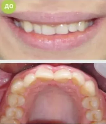 Мисс стоматология - майкоп стоматология, немецкая стоматология, лечение  зубов, протезирование, профилактика и гигиена зубов, лечение десен,  отбеливание зубов - Протезирование без обточки - Новинка!