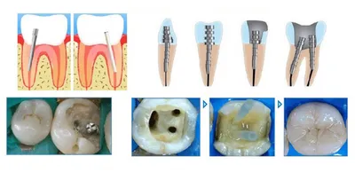 Стекловолоконные штифты для восстановления зуба | Эстетическая реставрация  штифтами из стекловолокна
