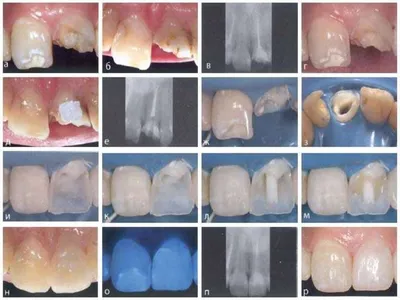 Установка штифта: поставить зуб на стекловолоконный штифт, наращивание и  восстановление – Поли Магия