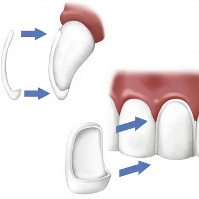 Протезирование зубов коронками в стоматологии SmileDent в Подольске
