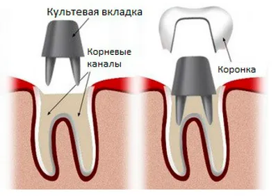 Восстановление невитальных зубов (3724) - Терапия - Новости и статьи по  стоматологии - Профессиональный стоматологический портал (сайт) «Клуб  стоматологов»