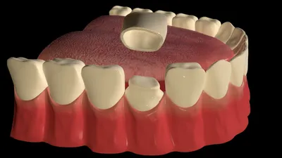 Художественная и эстетическая реставрация, восстановление и наращивание  зубов