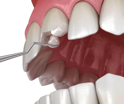 Художественная реставрация зубов — цена эстетической реставрации  разрушенного зуба в стоматологии Доктор Бон