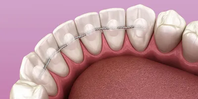 ПНИПУ: Зубные протезы из стекловолокна