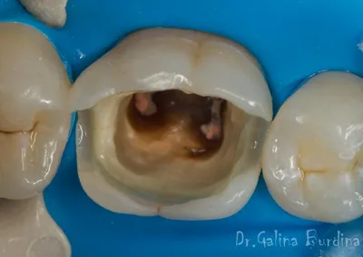Слетела коронка с зуба — что делать при выпадении протеза, советы от  стоматологии