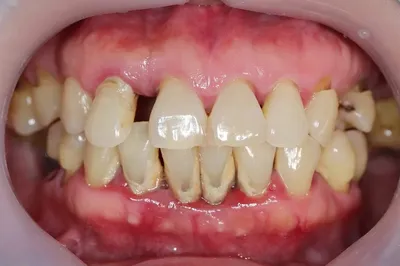 Шинирование зубов при пародонтите в стоматологии цены и фото