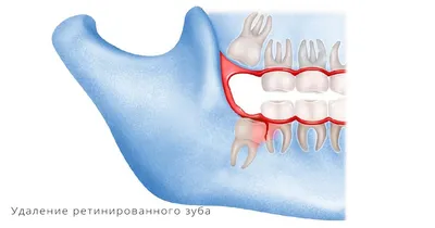 Какие зубы лучше вставлять - atlantida74.ru