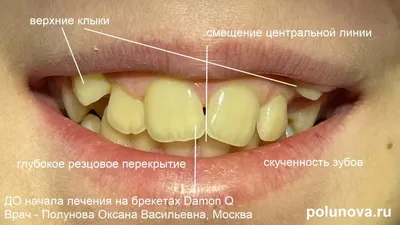 Зуб мудрости» или «восьмой» зуб: лечим или удаляем?