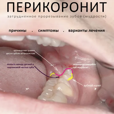 Можно ли удалить зуб без восстановления, опасность