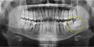 зубы мудрости — IMPLANT-IN.COM — дентальная имплантация. естественно.