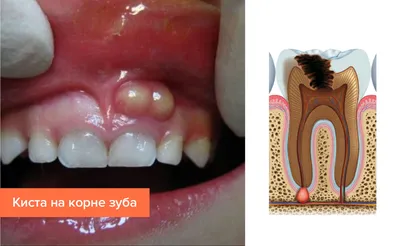 Киста зуба, обнаруженная на компьютерной томограмме зубов