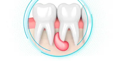 Киста, гранулёма зуба - Стоматологическая клиника Дентсервис