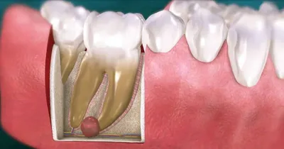 Киста корня зуба под коронкой – почему возникает патология, как ее  распознают и лечат