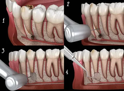 Киста зуба. Лечение. S.I.Y. Dental