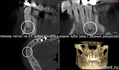 Киста зуба - что это, причины кисты зуба, стадии, симптомы, виды и лечение  кисты