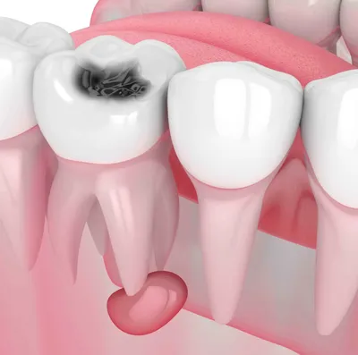 Киста зуба, обнаруженная на компьютерной томограмме зубов