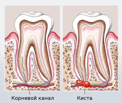 Киста зуба и все, что должен знать пациент стоматолога в Харькове