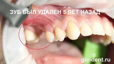 Лечение / удаление кисты зуба Хабаровск → Стоматология Oral Clinic