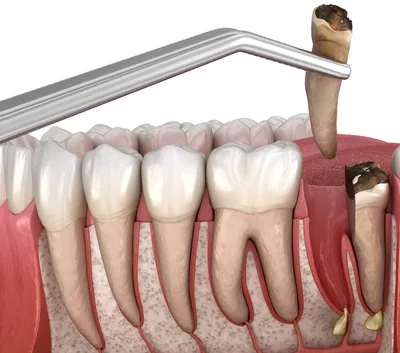 Можно ли спасти зуб с кистой от удаления? - atlantida74.ru