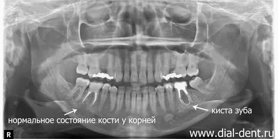 Хирургическое удаление кисты, гранулемы зуба, операция цистэктомия с  резекцией верхушки корня