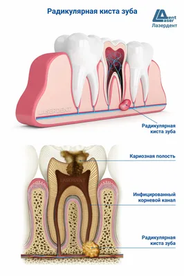 Киста зуба: лечение (удаление), причины, симптомы