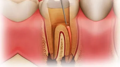 Киста после удаления зуба: кто виноват и как лечить заболевание | Dental Art