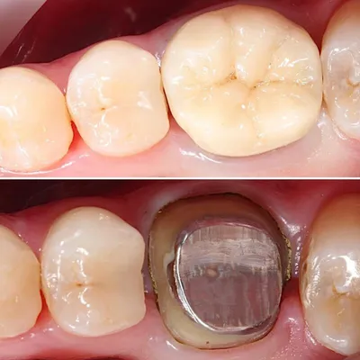 КУЛЬТЕВАЯ ВКЛАДКА СПАСЛА РАЗРУШЕННЫЙ НА 2/3 СОБСТВЕННЫЙ ЗУБ! -  Стоматологическая клиника Лазурит