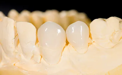 Зубные вкладки в стоматологии — плюсы и минусы, установка, показания —  Startsmile