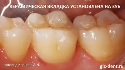 Цельнокерамические вкладки для 6 нижнего зуба - Немецкий имплантологический  центр