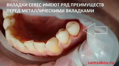 Вкладка на зуб CEREC вместо металлической вкладки, преимущества вкладки  Cerec