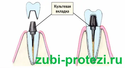 Культевые зубные вкладки - drkondratev.ru