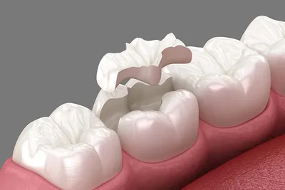 Зубные вкладки и зубные пломбы – в чем разница?