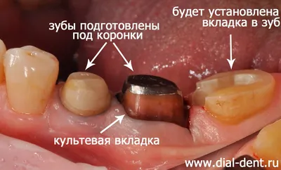 Керамические вкладки быстро набирают популярность как эффективный метод  восстановления поврежденного зуба. | SMAGA dental clinic