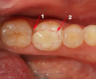 🦷 Вкладка на зуб ☑ Стоматология в Киеве и Львове ☑ Giorno Dentale