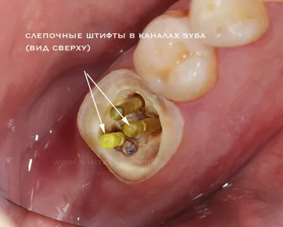 Керамические Вкладки Цена Киев На Зубы Фото ЛюмиДент