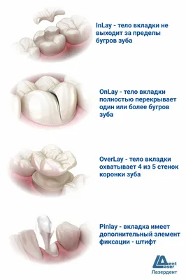 Центр стоматологии «МК» - ❓ Вы знаете, что такое керамическая вкладка  E-max? И когда ее применяют? 👉 На фото – восстановление 16-го зуба  пациента при помощи керамической вкладки E-max. Дело в том,