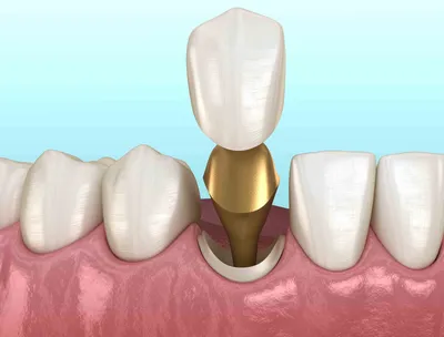 Вкладки на зубы в стоматологии - цены в Москве