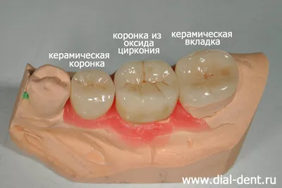 Восстановление зубов вкладками и коронками