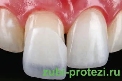 Зубные вкладки на зубы вместо пломбы: микро протез, который ставится в зуб,  восстанавливая разрушенную часть