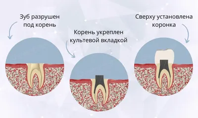 Восстановительные вкладки на зубы. Технология восстановления зубов, их цены  в Москве.