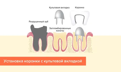 Культевая вкладка под коронку – что это такое, как делают, фото и установка  штифтовой культевой вкладки в зуб