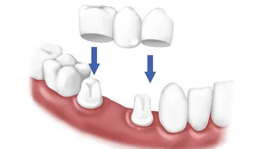 Способы восстановления зубов: протезирование вкладкой или коронка