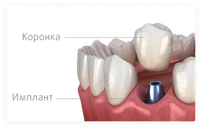 Коронка на зуб: цены под ключ на установку зубных коронок, этапы  протезирования — ROOTT