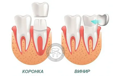 Коронки на зубах занизили прикус и разрушили другие зубы – клиника Smile  STD, Москва