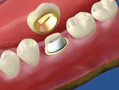Установка коронки E-Max (зуб обточен под коронку)